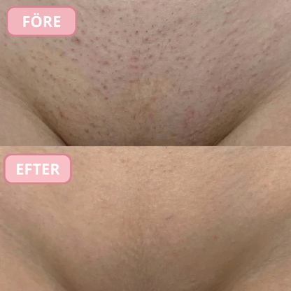 GIRLYS - INTIM'ER™ För intim Rakning utan Klåda