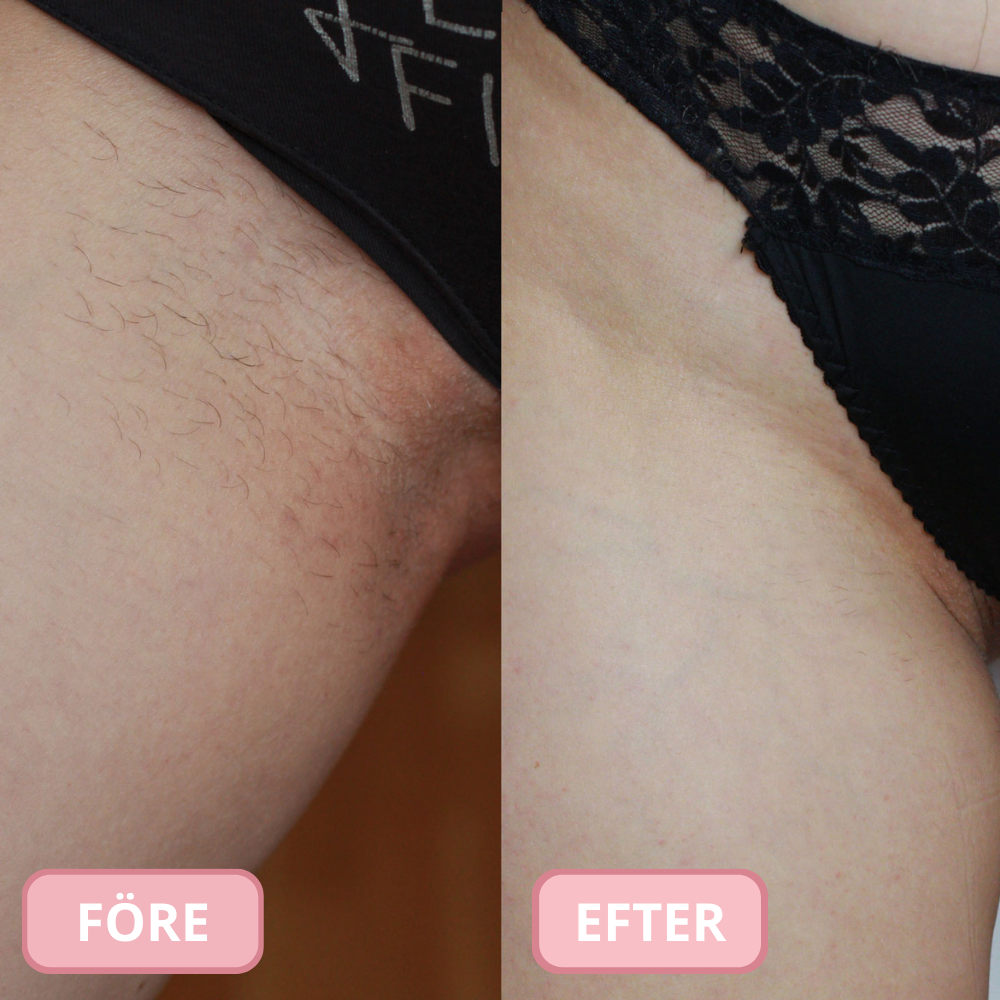 GIRLYS - INTIM'ER™ För intim Rakning utan Klåda